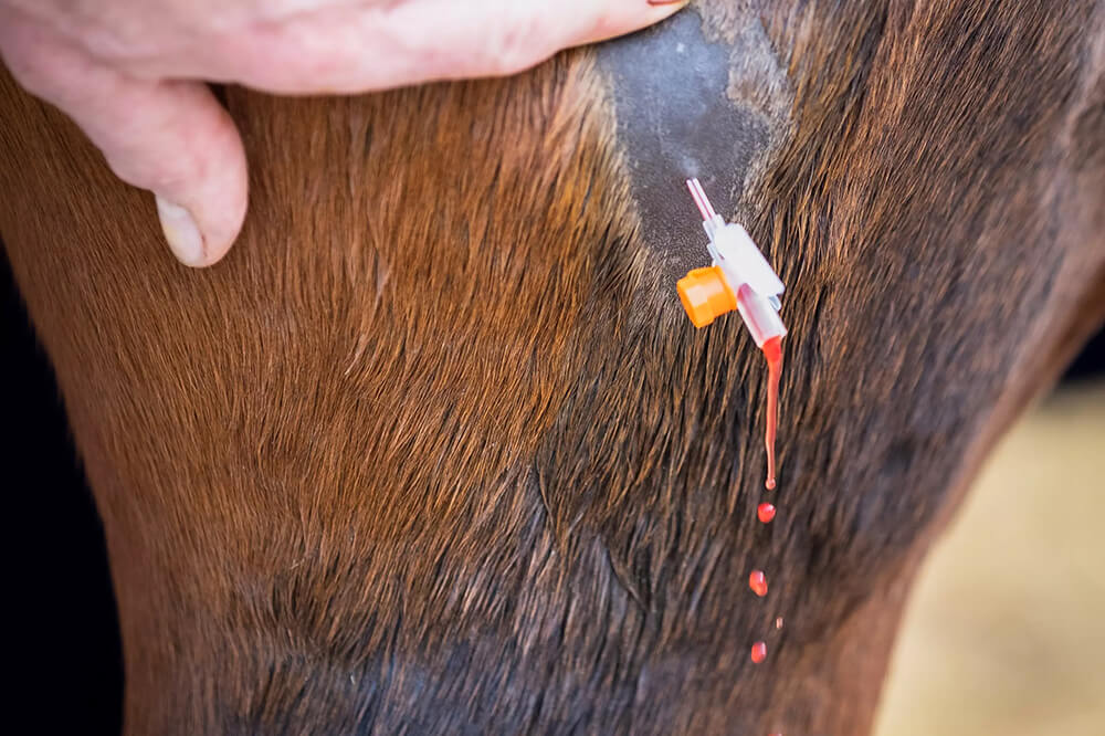 Flüssigkeit läuft aus dem Katheter der sich im Abzess befindet